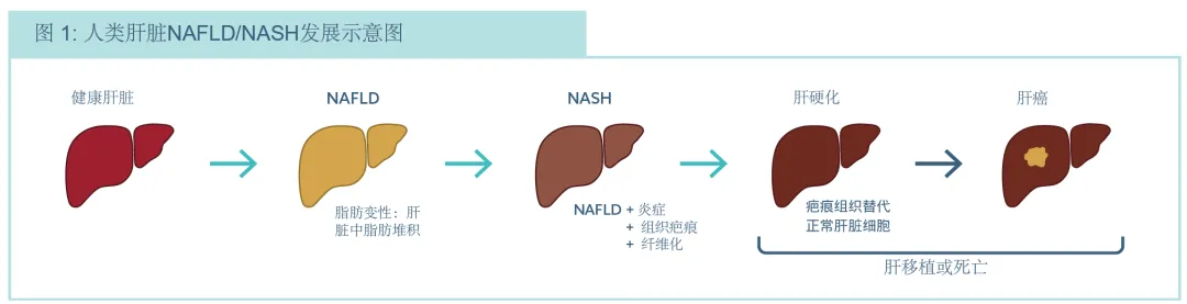 人类肝脏NAFLD/NASH发展示意图