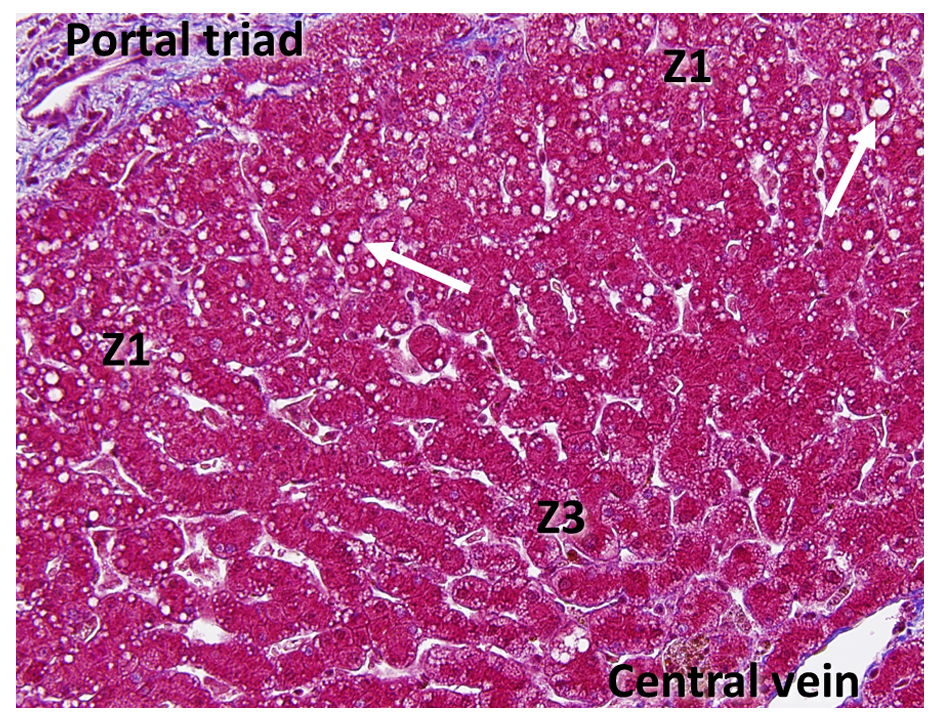 图2.脂肪肝组织病理学图像（三色染色），白色箭头指示脂滴。